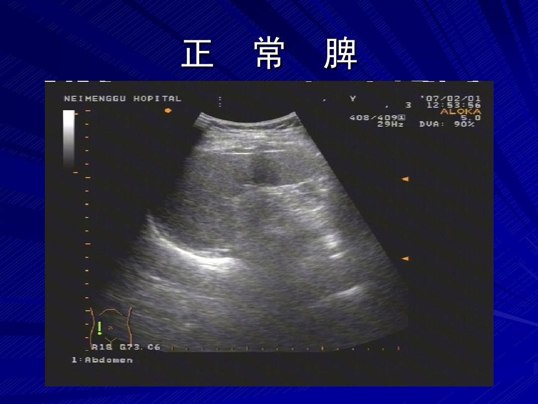 消化检查（10）：脾脏超声检查